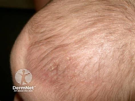 cradle cap in the elderly|Seborrhoeic Dermatitis .